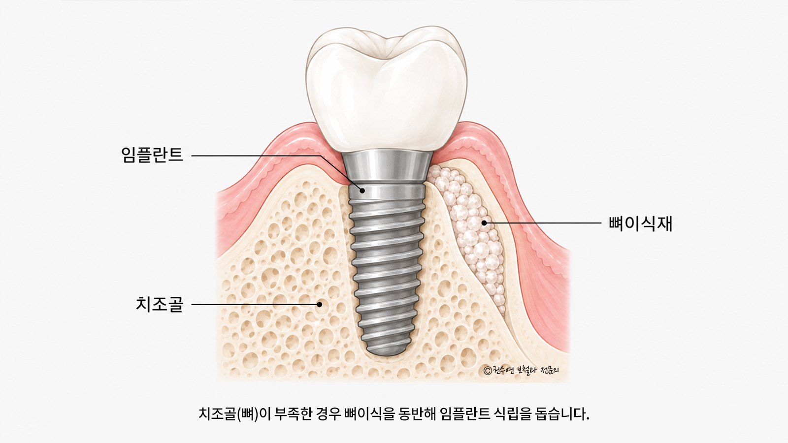 치조골이 부족한 경우 임플란트 뼈이식을 동반해 임플란트 옆에 뼈이식재를 채운 모습을 그린 단면 그림