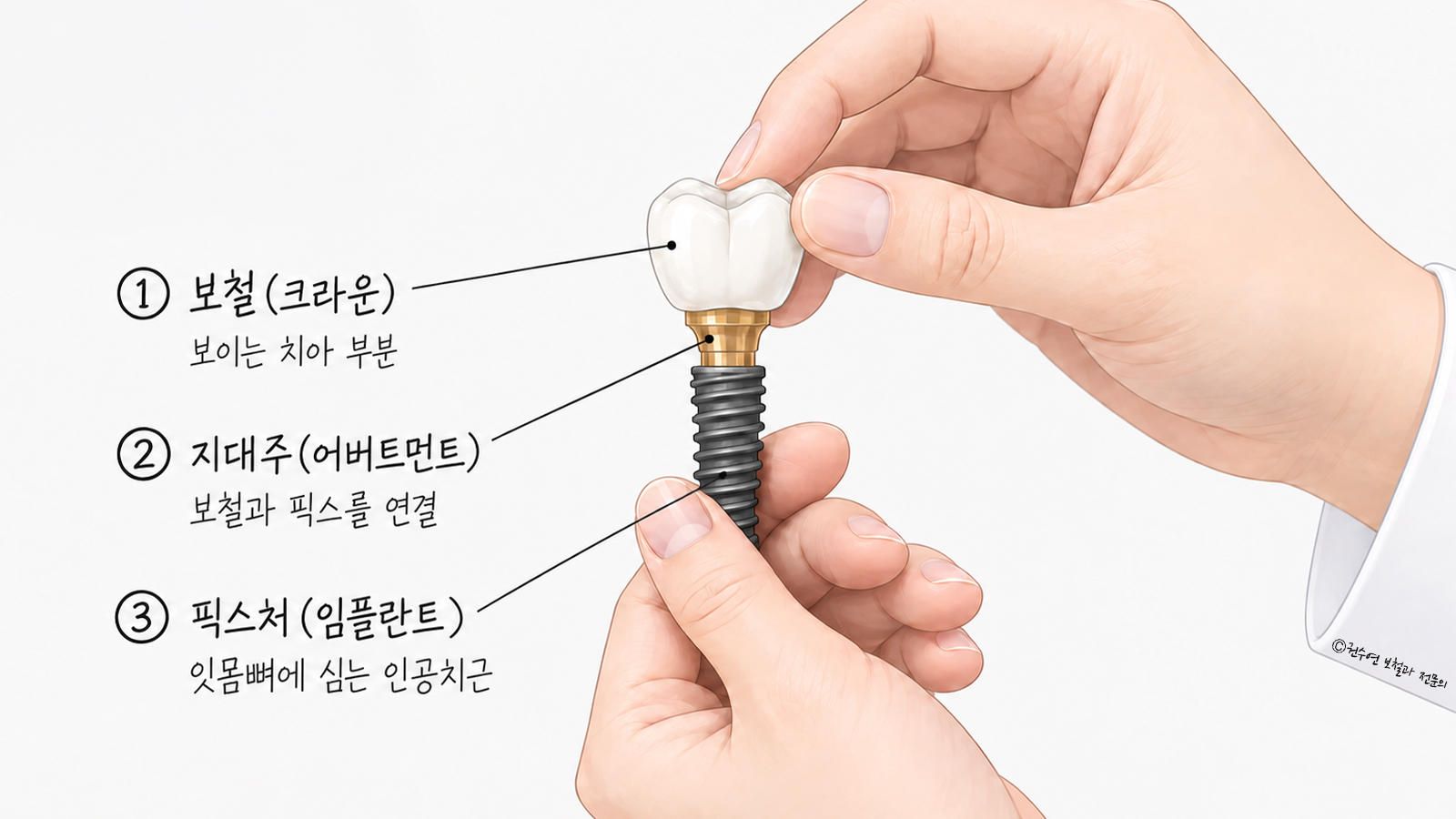 임플란트를 보철(크라운), 지대주(어버트먼트), 픽스처 세 부분으로 나눠 손에 들고 보여주는 그림